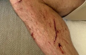 希勒骑车时因路面坑洞摔伤，手部和腿部有多处擦伤